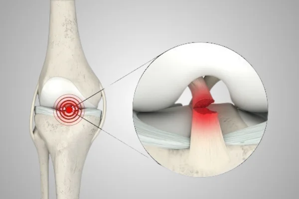 ACL Reconstruction